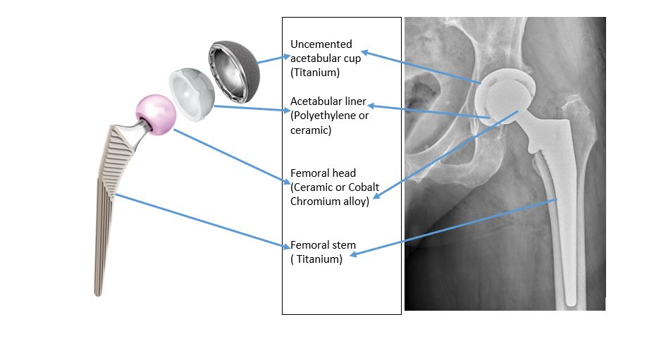 total hip replacement surgery tunbridge wells