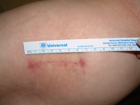 minimally invasive hip replacement tunbridge wells
