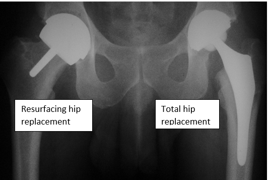 Resurfacing Hip Replacement Surgery In Tunbridge Wells Kent
