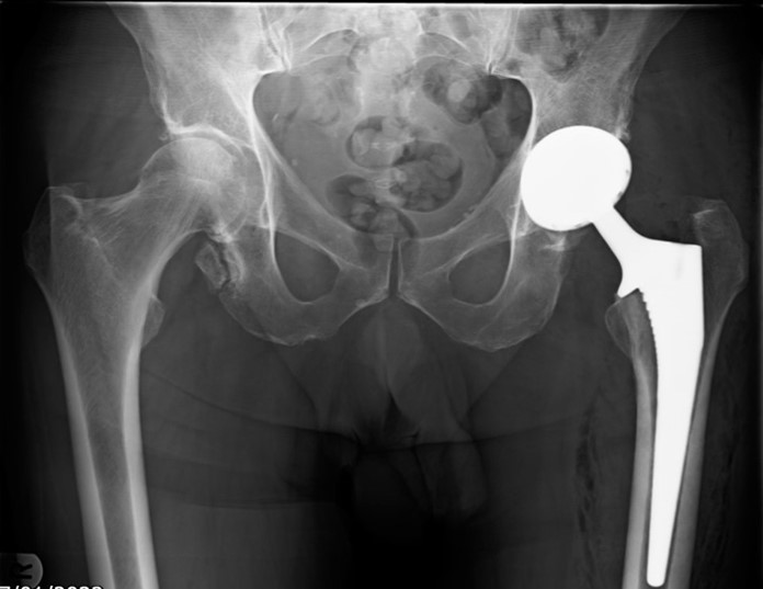 minimally invasive hip replacement surgery tunbridge wells
